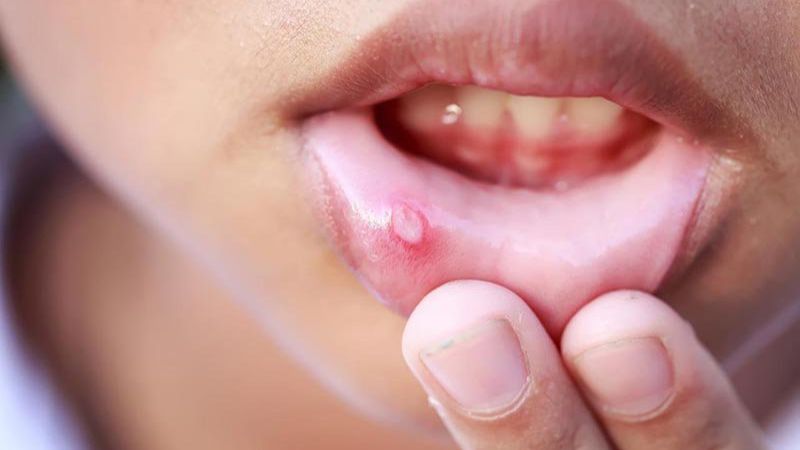 Nhiệt miệng nên làm gì? 9 cách chữa nhiệt miệng nhanh nhất
