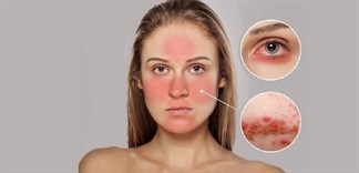 'Chữa cháy' cho làn da bị dị ứng mỹ phẩm