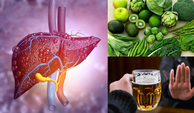 Người bị gan nhiễm mỡ nên ăn gì, kiêng ăn gì? 