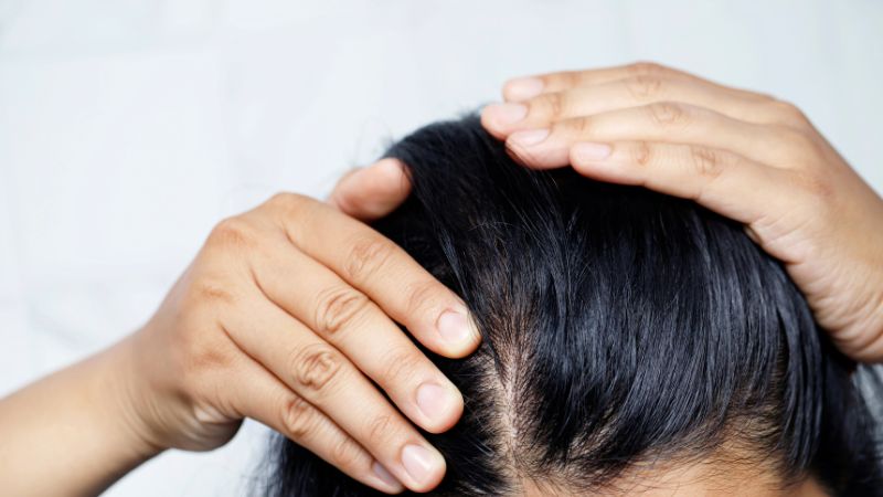 Cách chữa rụng tóc nhiều ở nữ giới không phải ai cũng biết.