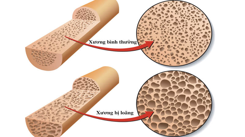 Cấu trúc so sánh giữa xương thường và xương bị loãng