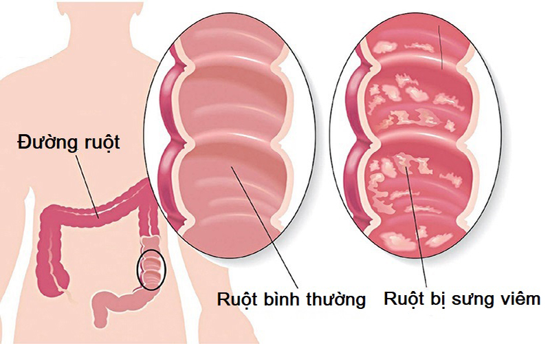 Một chế độ ăn không lành mạnh sẽ khiến cơ thể phải đối mặt với một số triệu chứng viêm, thường xảy ra trong đường ruột.