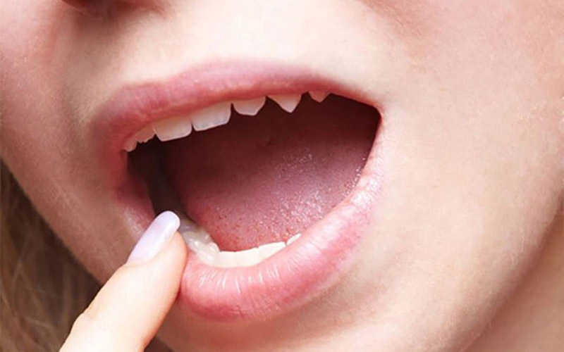 Một số người có thể bị mắc chứng gọi là “miệng xoài”. Các triệu chứng này bao gồm ngứa, sưng, và phồng rộp quanh miệng, môi và đầu lưỡi