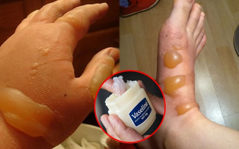 Hãy lấy Vaseline bôi lên vết bỏng, chỉ sau vài phút vết bỏng rát sẽ được làm dịu đi.