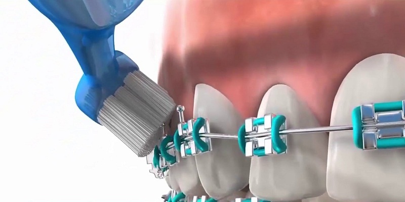 Những lưu ý chăm sóc răng miệng khi niềng răng