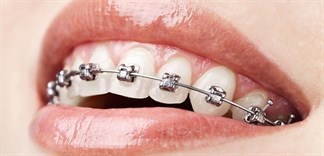 Những lưu ý chăm sóc răng miệng khi niềng răng