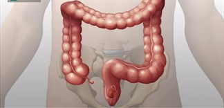 Làm sạch đại tràng nhờ vào phương pháp ăn uống