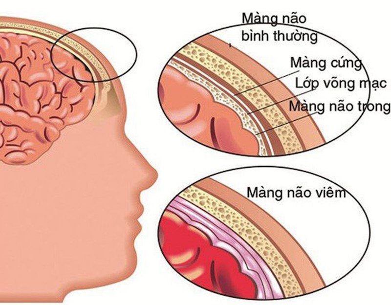 Viêm màng não