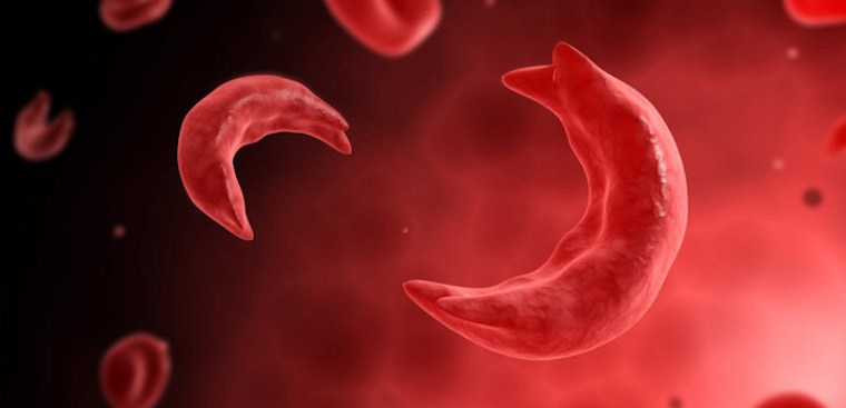 Hỗn hợp gen hemoglobin S (HbS) gây ra bệnh hồng cầu hình liềm như thế nào?
