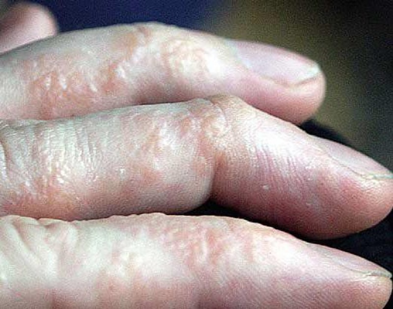 Bệnh tổ đỉa là gì, nguyên nhân mắc bệnh