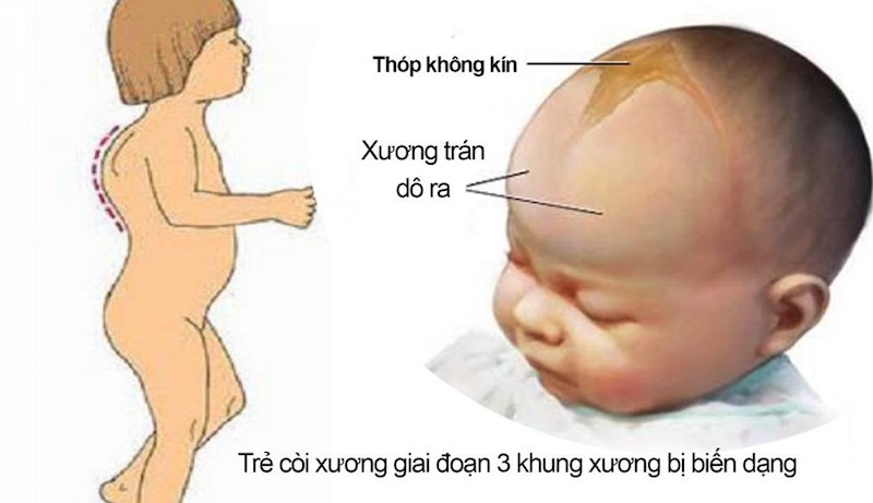 Triệu chứng của bệnh còi xương