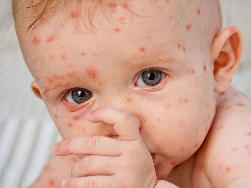 Bệnh Rubella là gì?