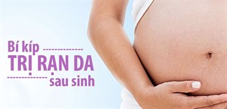 Mách các mẹ bỉm sữa cách trị rạn da ngay tại nhà mà vẫn hiệu quả tức thì