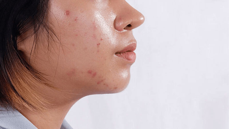 Quy trình các bước Skincare cho da dầu mụn ngày và đêm