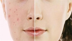 Cách trị thâm mụn bằng nguyên liệu thiên nhiên có sẵn tại nhà