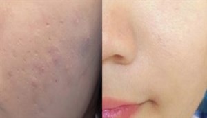 Trị mụn mãi chẳng hết, thử ngay những thức uống này mụn giảm ngay sau tuần
