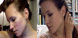 Nhờ chế độ detox đúng cách, cô gái này đã đánh bay mụn hoàn toàn