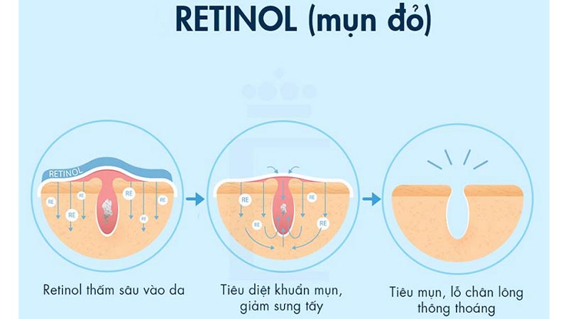 Retinol là gì? Cách sử dụng Retinol cho người mới bắt đầu