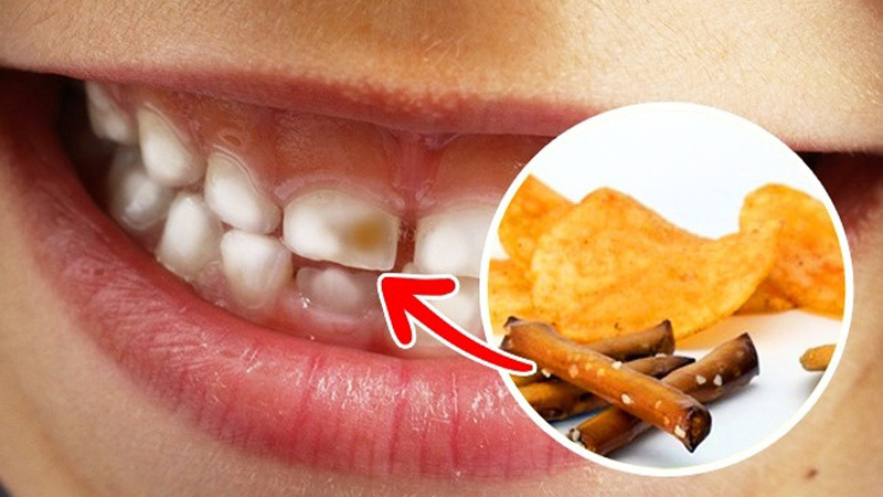 Theo như Hiệp Hội Nha Khoa Hoa Kỳ (ADA), thực phẩm và đồ uống chứa nhiều đường có thể thúc đẩy sâu răng