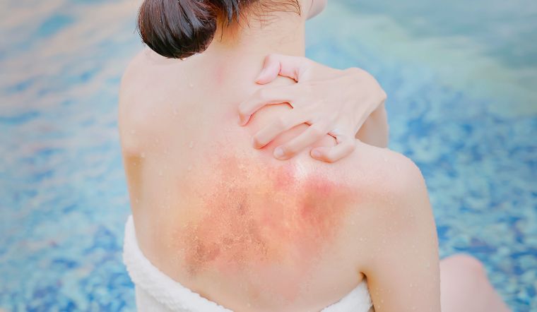 Sau khi đi nắng về hãy thực hiện việc này để làm dịu da nhanh chóng