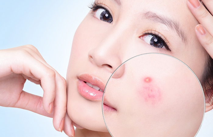 Salicylic acid là gì? Tác dụng và các sản phẩm có chứa salicylic acid Salicylic acid giúp trị mụn