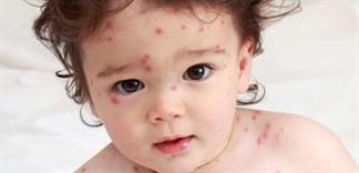  Bị thủy đậu kiêng gì để nhanh khỏi và không bị sẹo? 