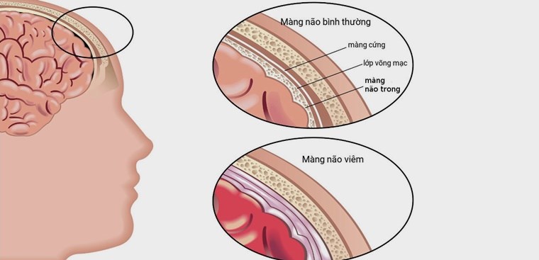 Làm thế nào để phòng ngừa viêm màng não?