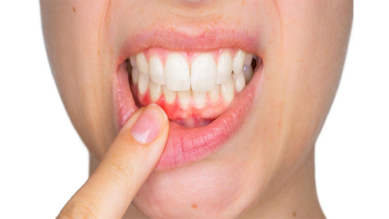 Điều trị mảng bám răng và ngăn ngừa viêm nướu
