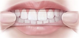 Ẩn họa từ miếng dán trắng răng