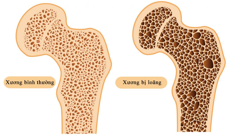 Ăn đậu phộng chống loãng xương