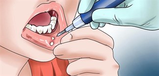 Những thành phần chính trong thuốc trị nhiệt miệng là gì?
