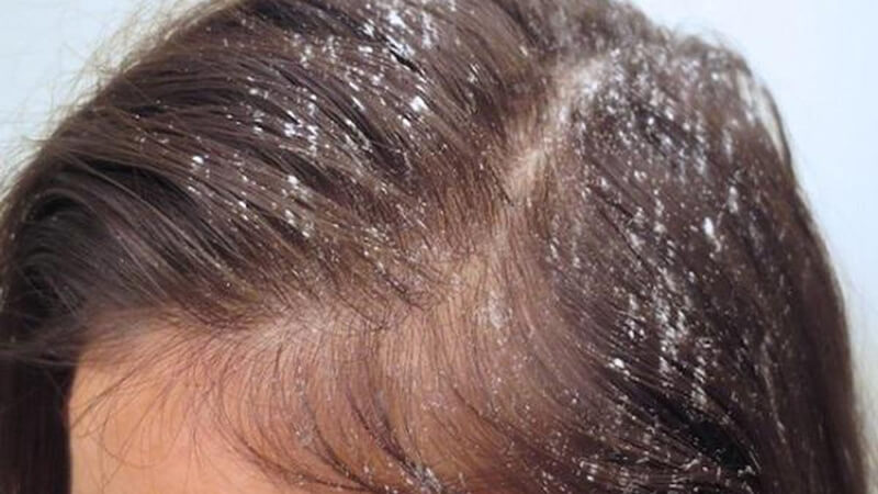 Tìm Hiểu ]: Gội đầu mà tóc vẫn bết dính phải làm sao?