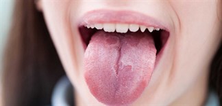 8 mẹo chữa rát lưỡi tại nhà đơn giản mà hiệu quả