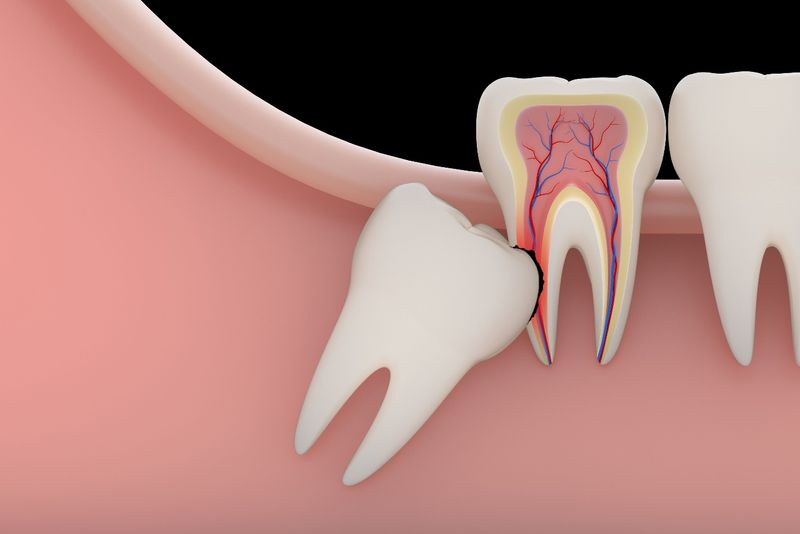 Răng khôn mọc lệch, mọc ngầm sẽ gây ra đau đớn, khó chịu, ảnh hưởng đến các dây thần kinh