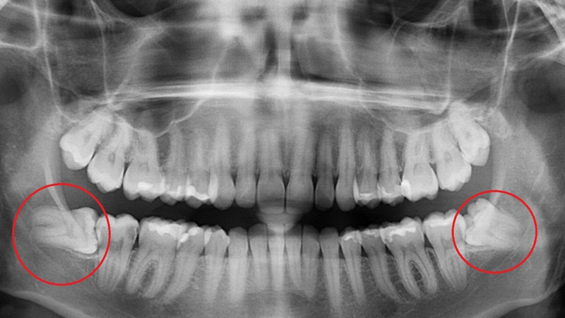 Răng khôn mọc lệch gây đau nhứt, mất thẩm mỹ và ảnh hưởng chức năng nhai