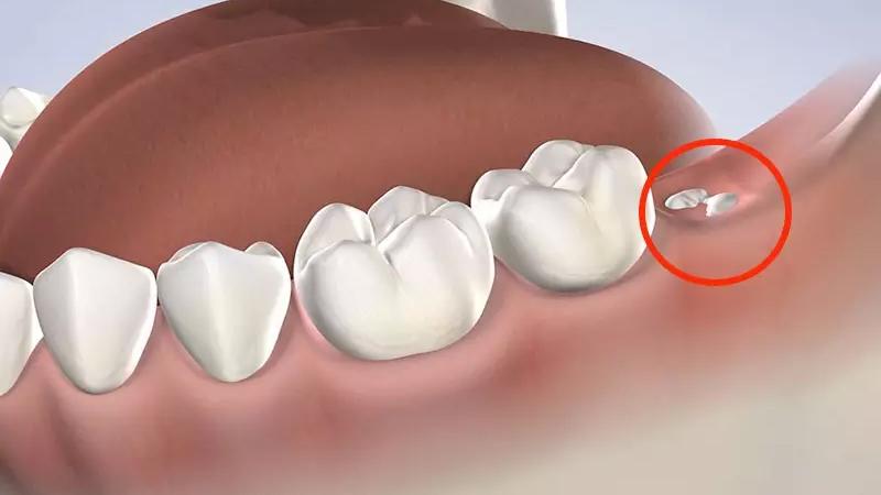 Đau răng khôn nên làm gì? 11 cách giảm đau răng khôn hiệu quả