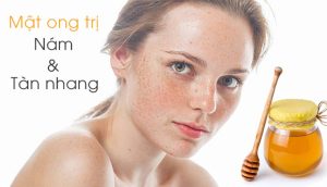 Ngoài trị mụn, mật ong còn có thể trị tàn nhang