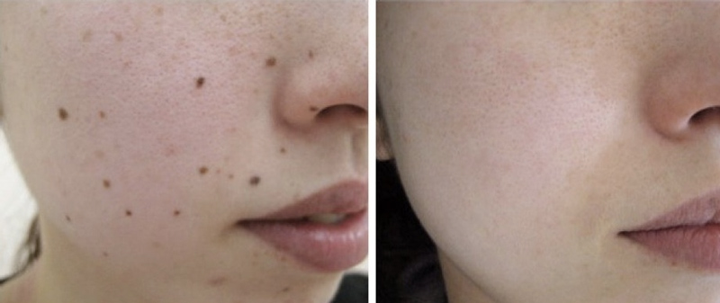 Top 5 Cách phá nốt ruồi trên mặt tốt nhất 3 Cách tẩy nốt ruồi đơn giản, dễ làm tại nhà