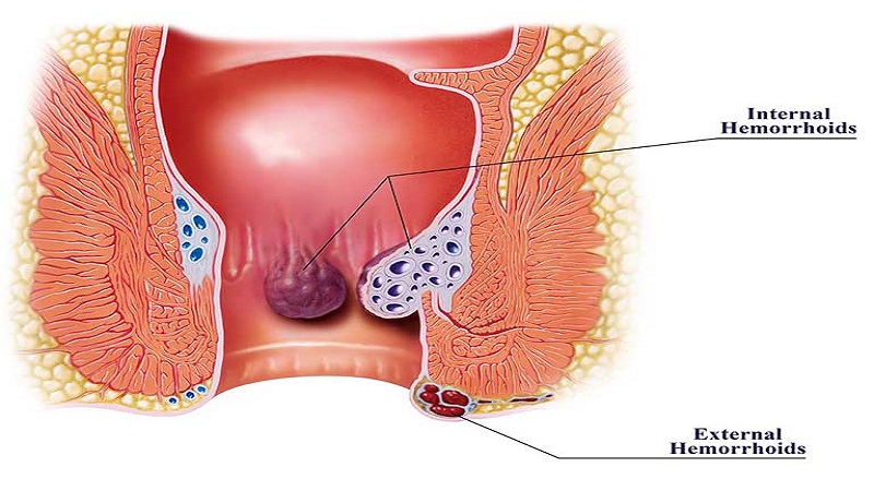 8 nguyên nhân đi cầu ra máu và cách điều trị, lưu ý cần biết