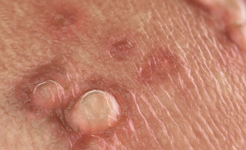 Virus HPV có thể gây ra bệnh gì?
