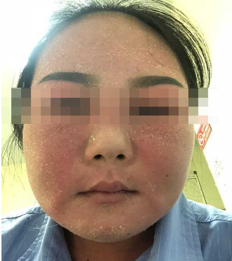 The harms of using floating whitening cosmetics