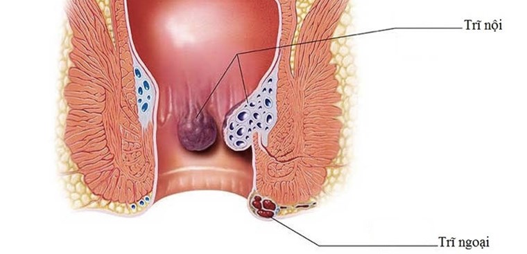 Trĩ nội và trĩ ngoại có nguyên nhân gì gây ra?
