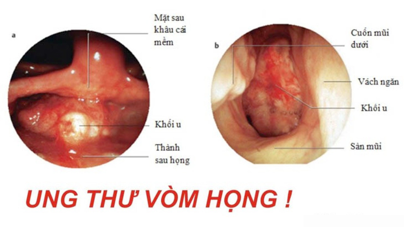 Ung thư vòm họng