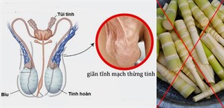 Tại sao giãn tĩnh mạch thừng tinh cần được kiêng khem?
