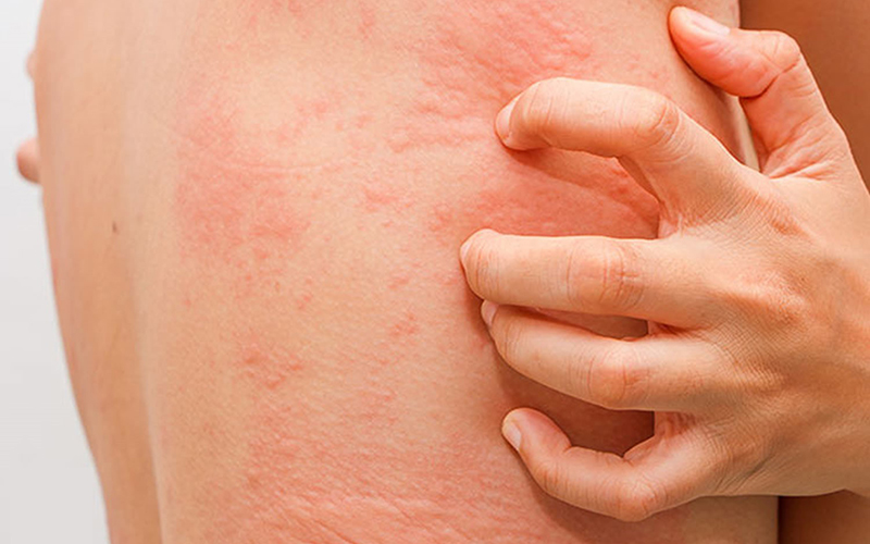 Người dễ bị dị ứng Người dễ bị dị ứng