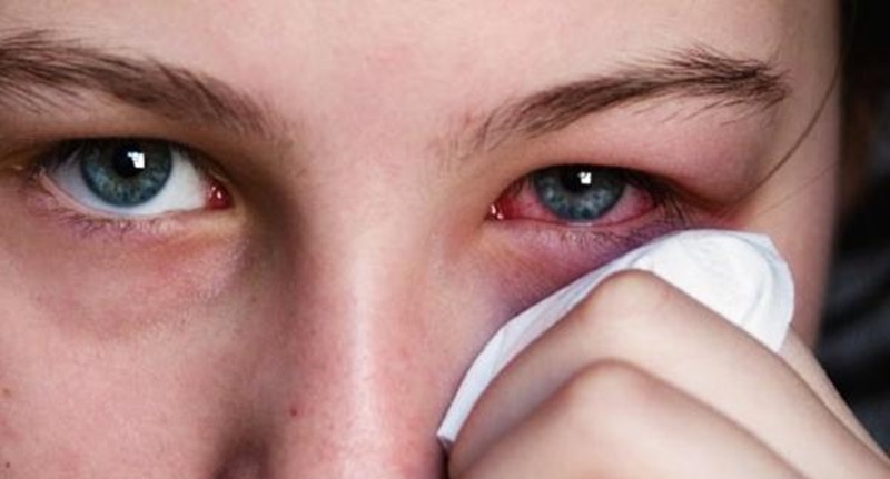 Các nhược điểm khi dùng kính áp tròng