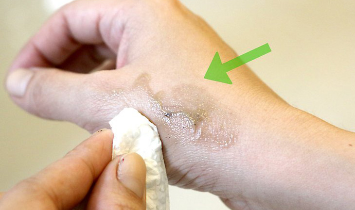 Tẩy thuốc nhuộm trên da là một nỗi ám ảnh đối với nhiều người. Nhưng đừng lo, hình ảnh này sẽ hướng dẫn bạn cách để tẩy màu thuốc nhuộm trên da hiệu quả và dễ dàng. Hãy thử ngay và cảm nhận sự khác biệt.