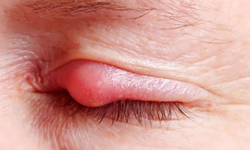 Lẹo mắt là gì, nguyên nhân, triệu chứng và cách điều trị