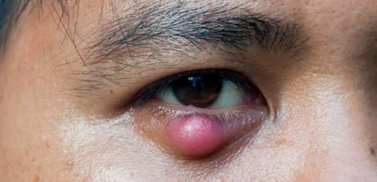 Lẹo mắt là gì, nguyên nhân, triệu chứng và cách điều trị