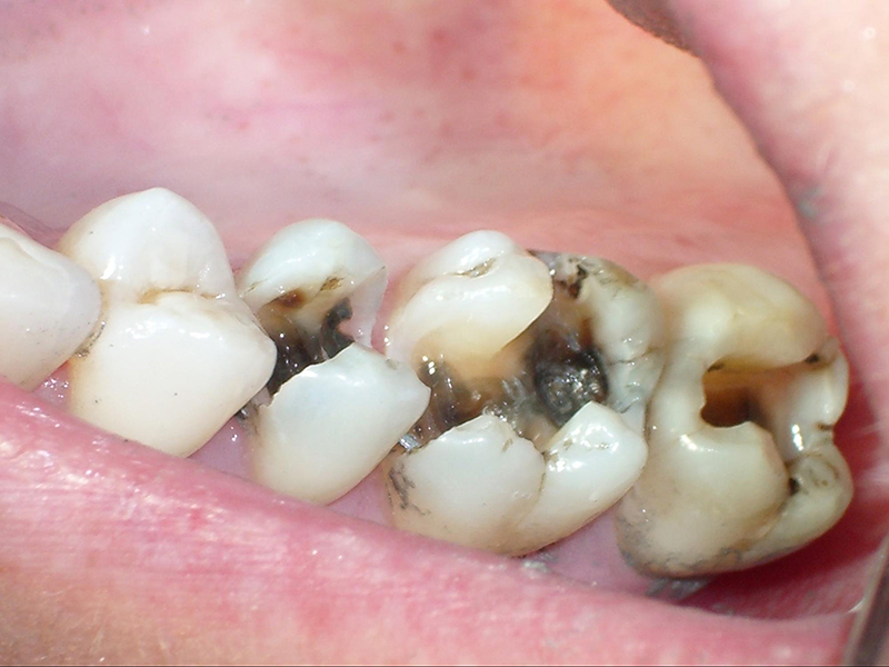 Đâu là vị trí dễ bị sâu răng nhất? Đâu là vị trí dễ bị sâu răng nhất?